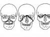 Лечение переломов верхней челюсти Перелом верхней челюсти по лефор 2 лечение